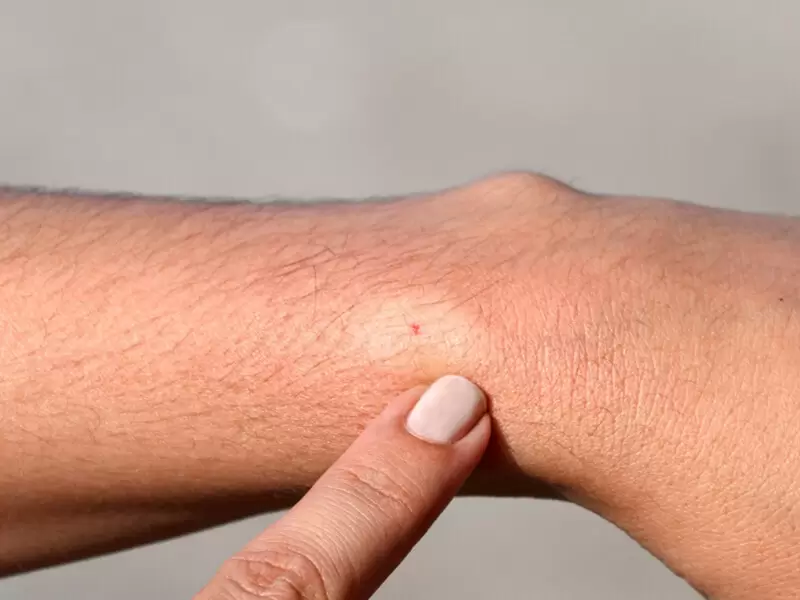 Travazol Krem Ne İçin Kullanılır? 3 Travazol Krem Böcek Isırıkları Veya Arı Sokmaları İçin Kullanılabilir Mi?